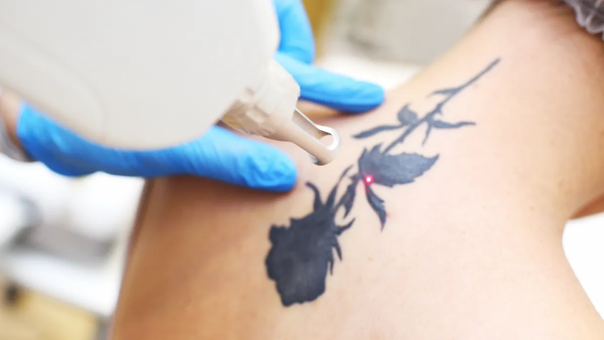 Q-Switched Laser & Tattoo Removal at Delphi Skin Clinic:Erasing the Past, Revealing Your Confidence