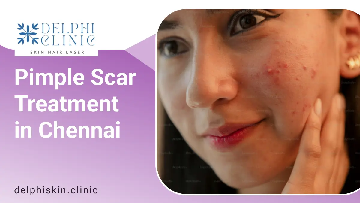 Pimple Scar Treatment in Chennai| Delphi dkin clinic